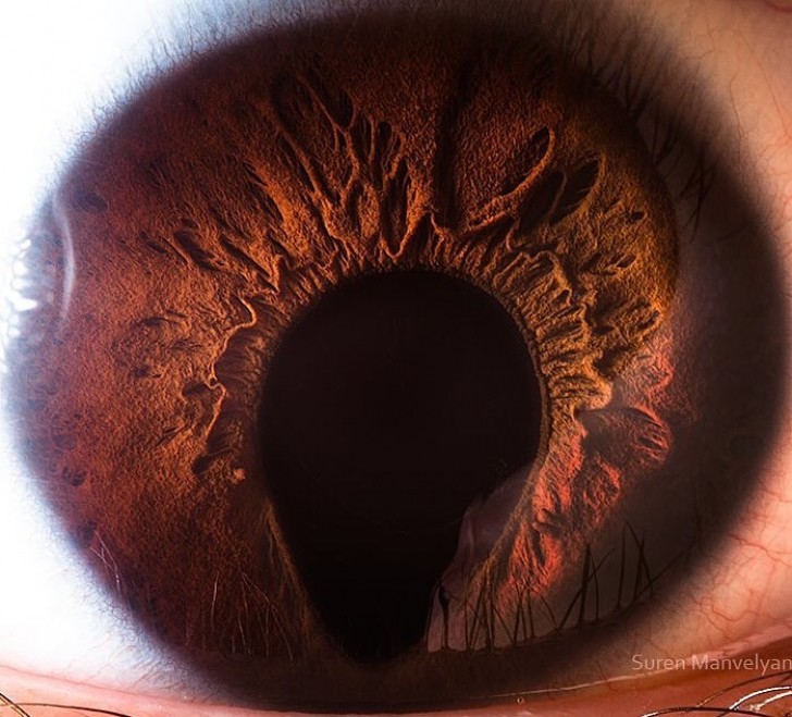 Occhio umano con coloboma, una rara condizione dell'occhio che può alterare la corretta visione. 