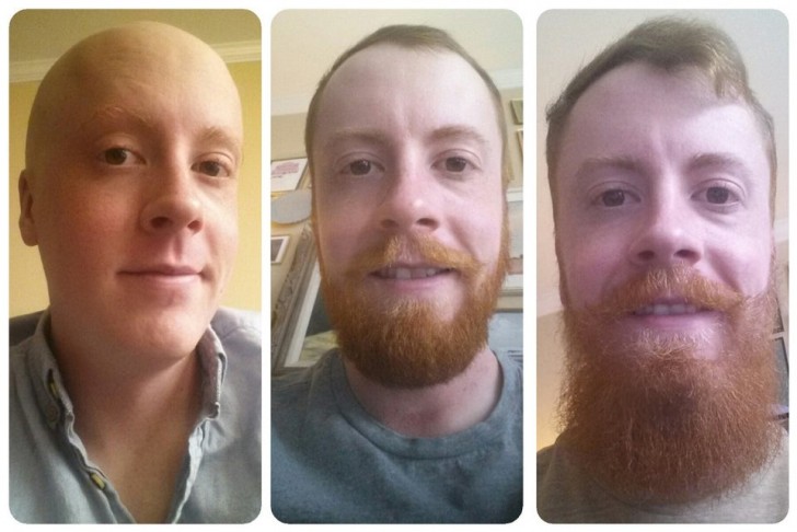 13. "I've been growing my beard and hair for 10 months and ... I no longer have cancer!"