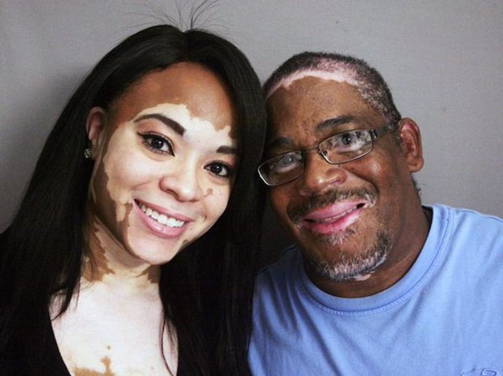 Toda a beleza do vitiligo hereditário: do pai... à filha!