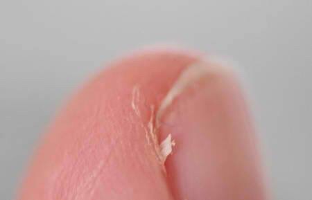 Wanneer je je nagels verkeerd knipt en dat kleine pijnlijke stukje achterblijft.