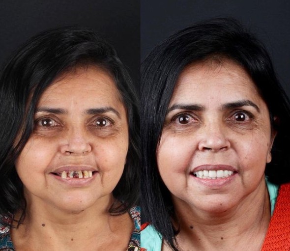 1. Una dentatura completamente nuova per un sorriso luminosissimo: sembra davvero un'altra persona.