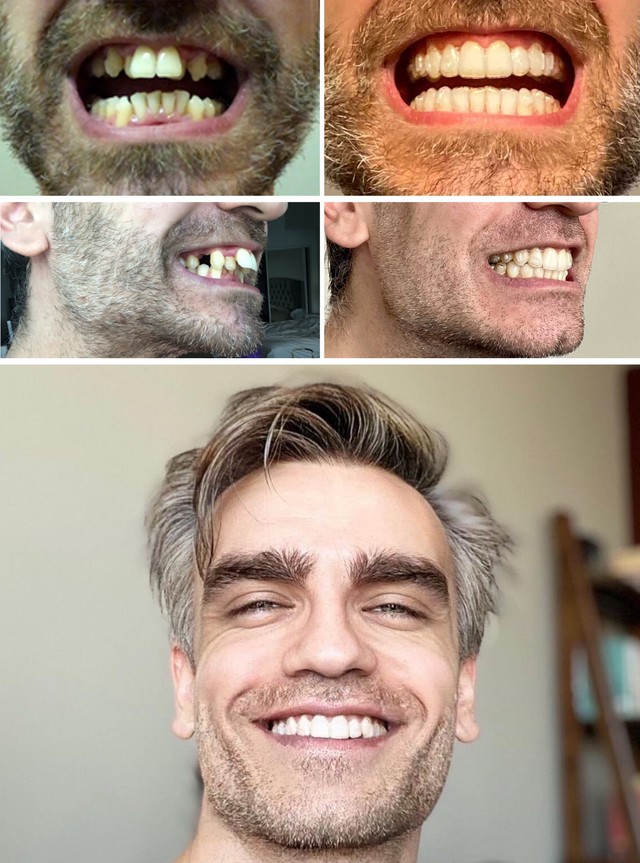 Depois de uma vida com os dentes tortos, decidi resolver o problema e fazer algo com a minha aparência - essa é a diferença em um ano!