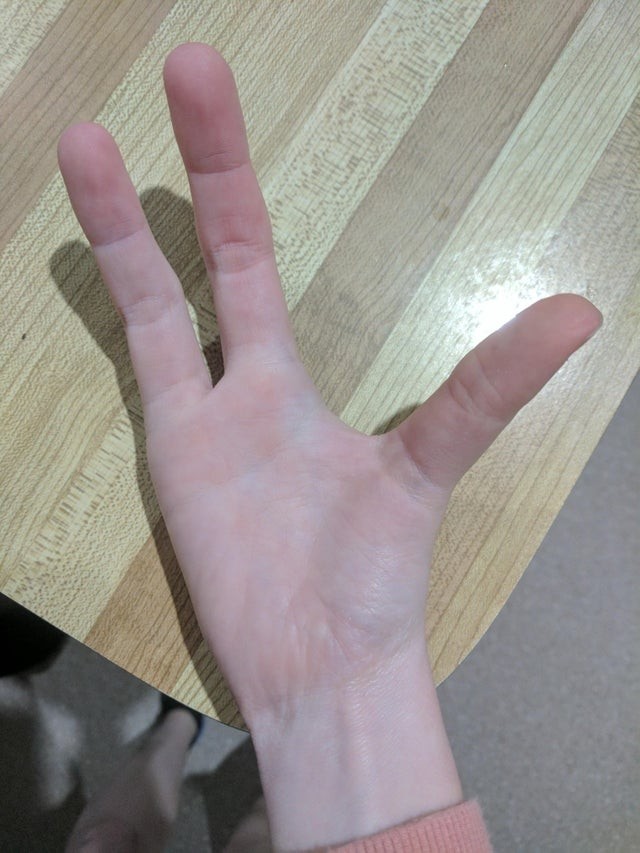 12. Cette personne est née avec deux doigts en moins à la main droite.
