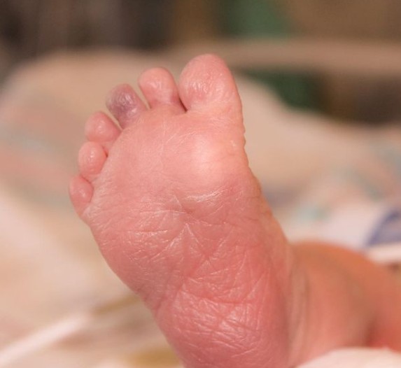 15. Un bébé né avec six orteils.
