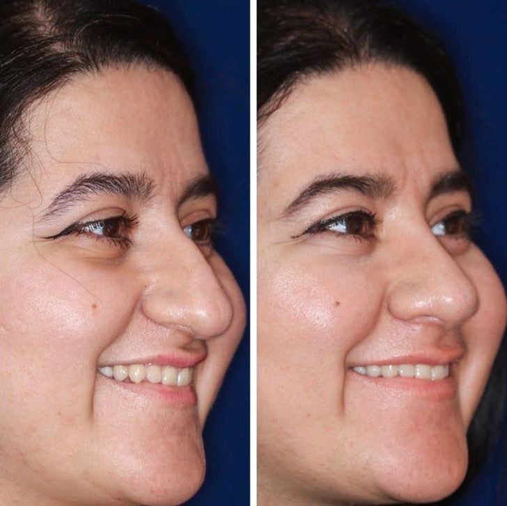 10. By adjusting the nose, the smile also looks different