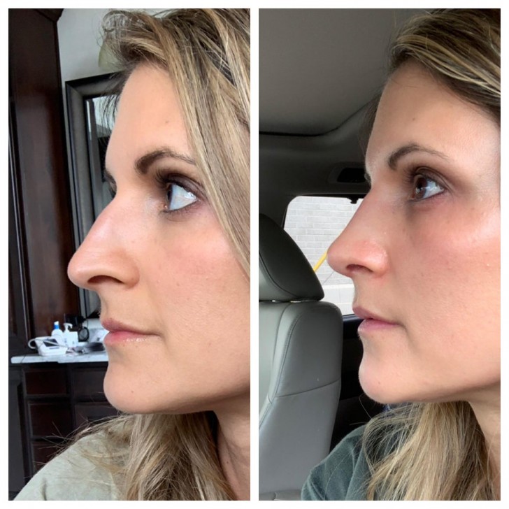 11. Une autre rhinoplastie sur une femme de 38 ans, satisfaite de son "nouveau" nez.