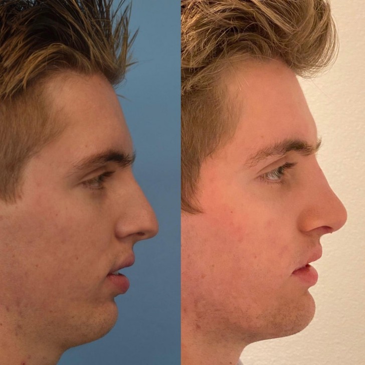 14. 17 jours seulement après une rhinoplastie et une implantation du menton : voici les résultats !