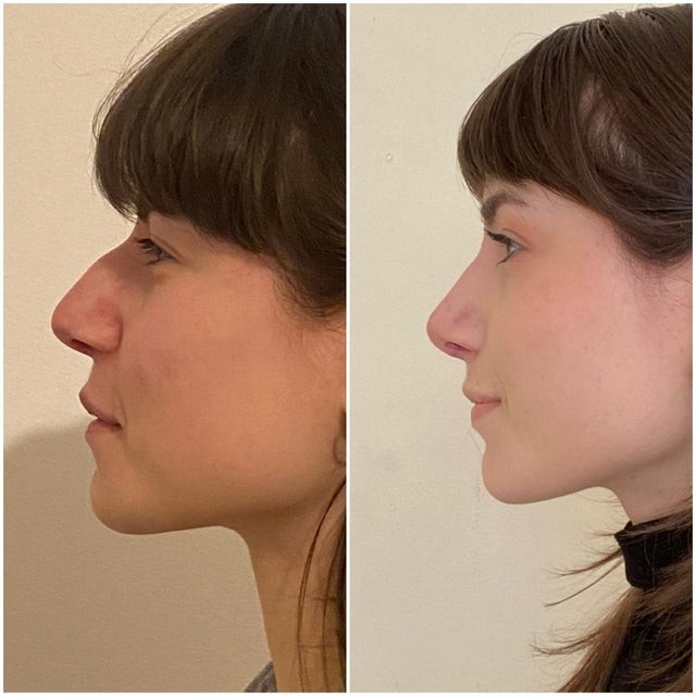 2. Rhinoplasty, 3 weeks after the surgery!
