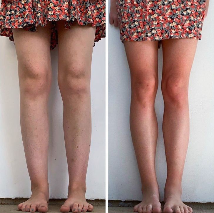 3. ¿Ven la diferencia entre las piernas después de un año de la operación?