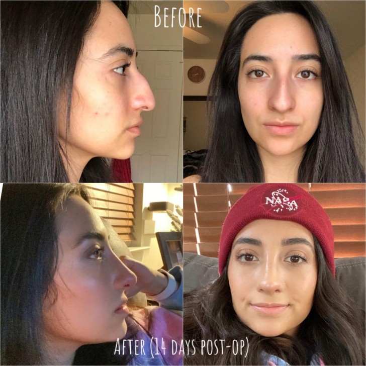 4. Cette fille a elle aussi opté pour une rhinoplastie.