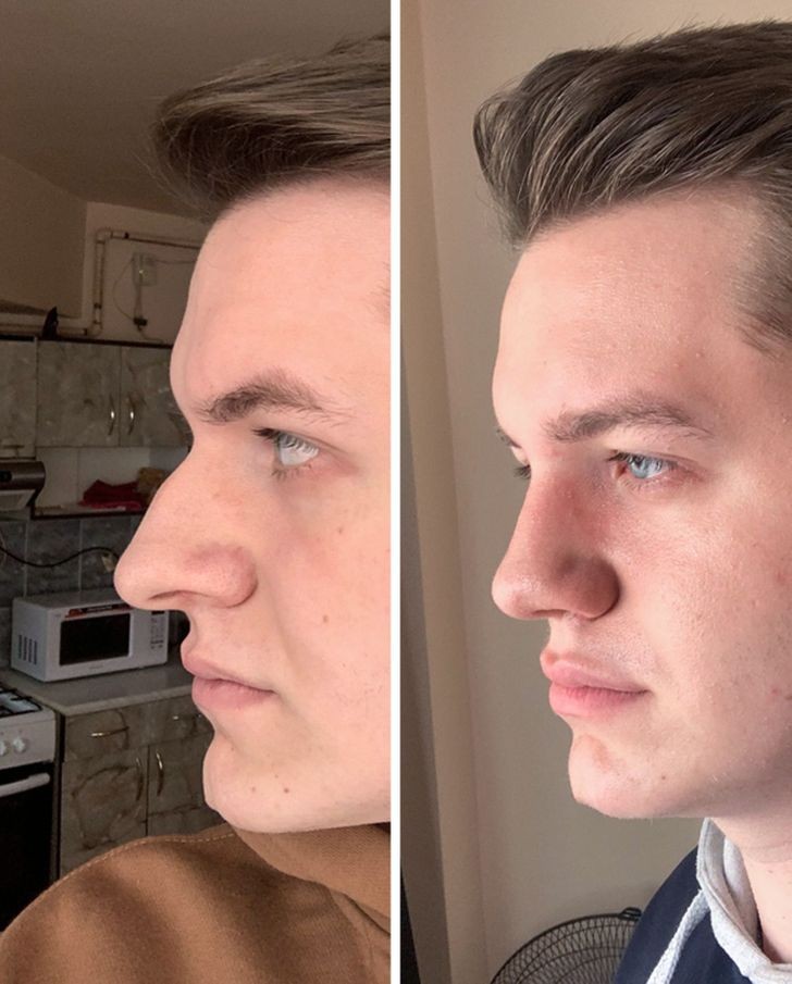 9. At 21, he decided it was time for a septum-rhinoplasty