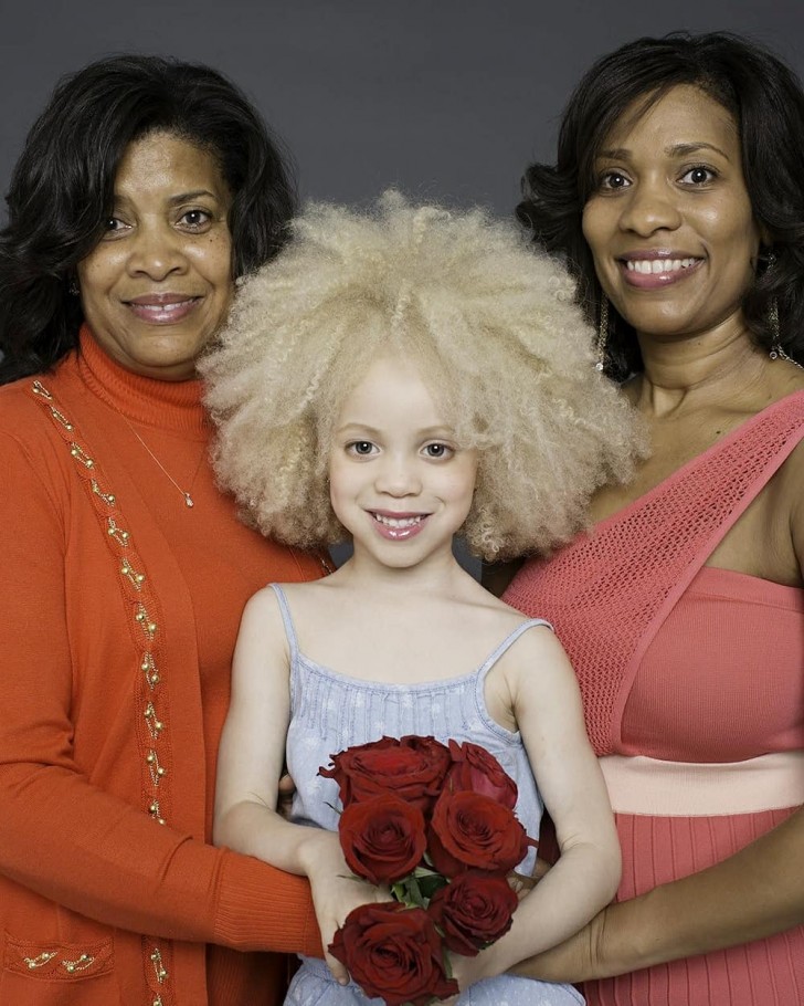 8. Ava Clarke is an albino girl