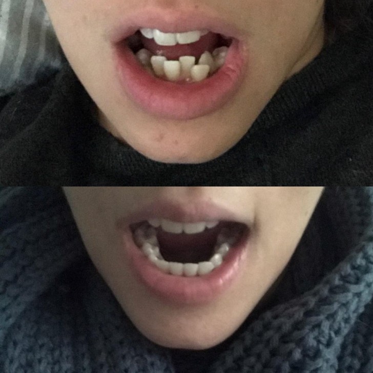 11. Sie hat endlich ihre Zahnspange abgenommen bekommen, und das Ergebnis ist unglaublich.