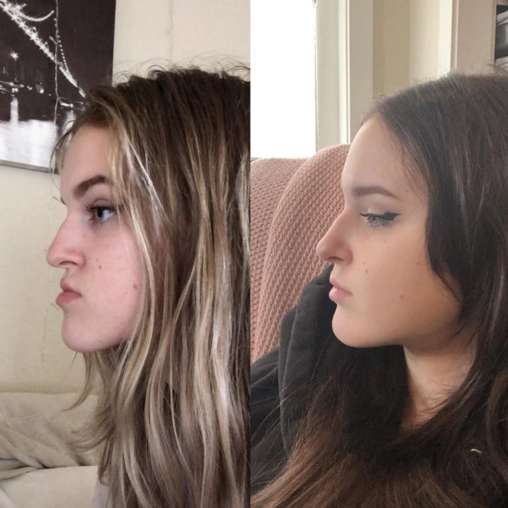 13. Un doppio intervento alla mandibola ha permesso a questa adolescente di avere un profilo più gradevole e sentirsi meglio con se stessa.
