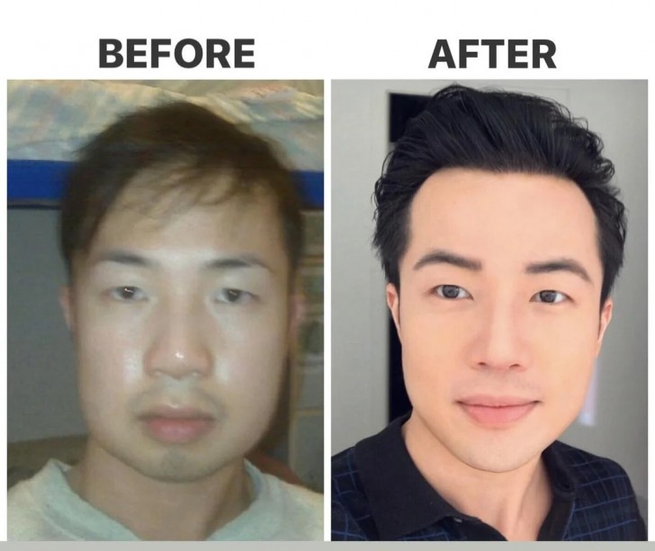 5. Dieser Mann entschied sich für mehrere Operationen, um sein Aussehen zu verbessern