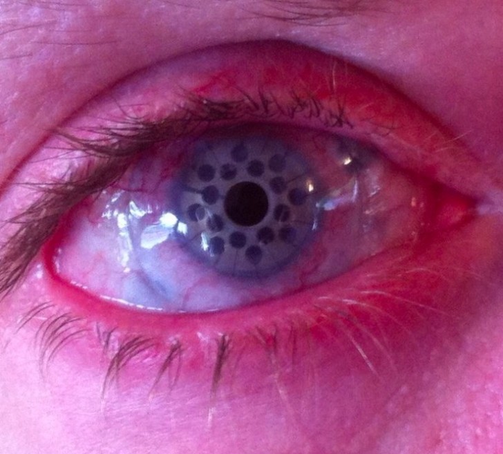 2. "Hoe het oog van mijn oom genas na de operatie: er vormden zich talloze bolletjes"
