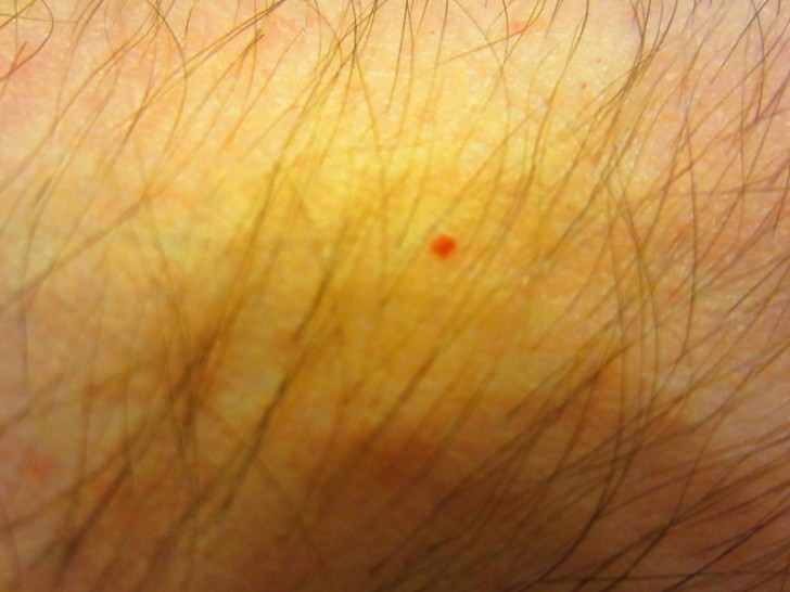 De rode puntjes die op de huid verschijnen