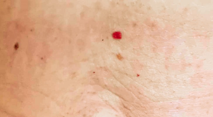 De dyker upp från en dag till en annan på kroppen: vad indikerar dessa röda prickar - 2
