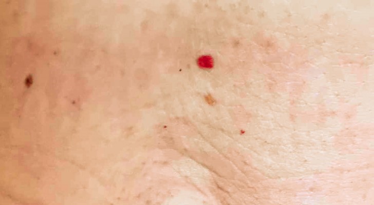 Ze verschijnen van de ene op de andere dag op het lichaam: wat betekenen die rode puntjes? - 2