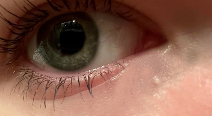 Naturläkemedel mot vita pustler på ögonlocken: vad ska man göra?