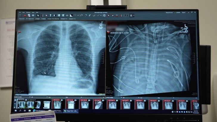 Trettiofyraåringen behövde en transplantation av båda lungorna: han hade rökt vaporizers i tio års tid.
