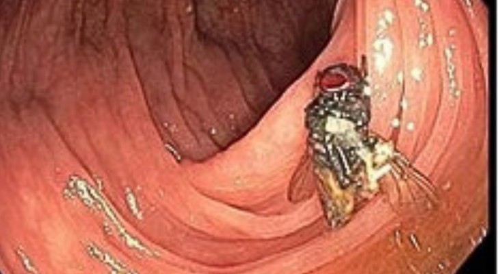 Mosca intera nel colon di un uomo, l'ipotesi dei medici