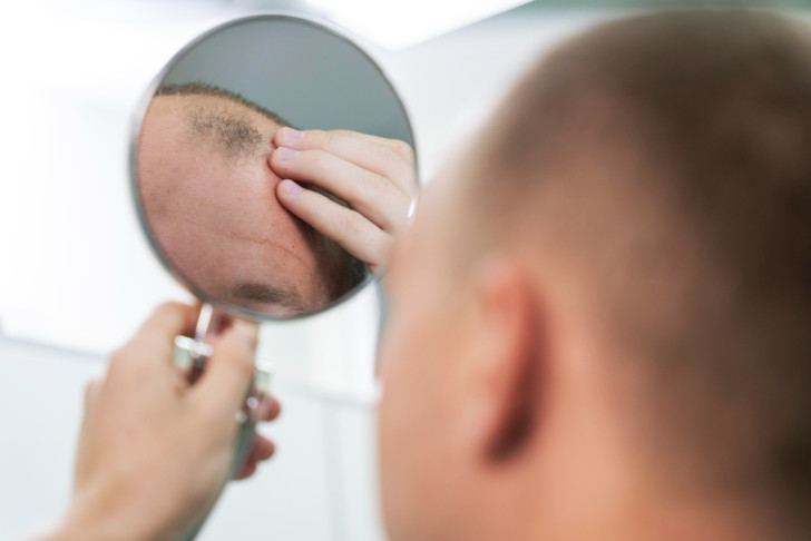 La perdita di capelli si può ripristinare o prevenire?