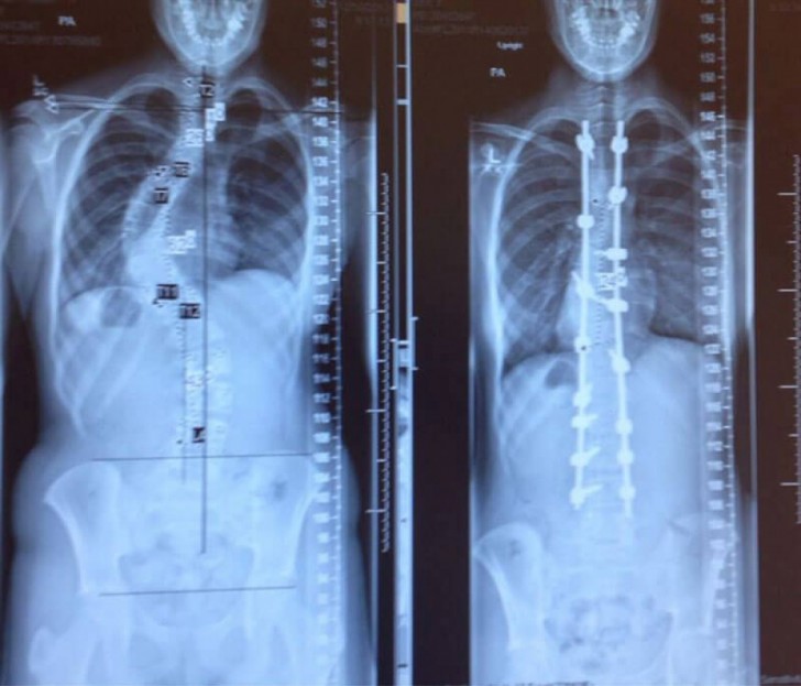4. Radiografie di una colonna vertebrale, prima e dopo il trattamento per la scoliosi