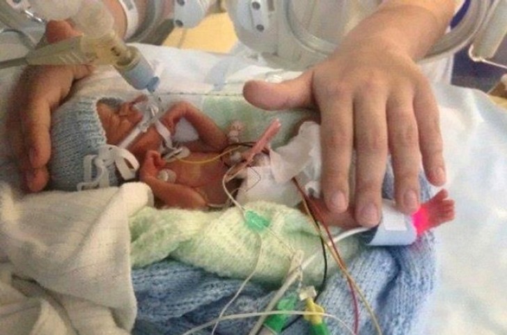 Alla nascita pesava 500 grammi, ora è un bambino in piena salute.