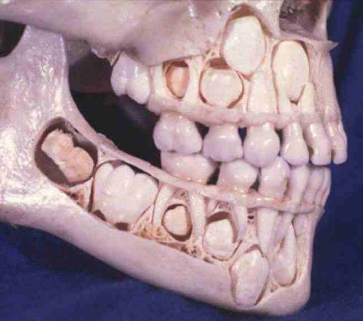 14. Lo scheletro di un bambino che non aveva ancora perso i denti da latte