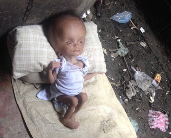 Un jour, elle est arrivée au centre médical où travaillait une maman avec son petit enfant hydrocéphale et atteint de malnutrition, nommée Nika.