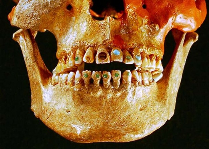 Les dentistes de l’époque perçaient la dent avec l’obsidienne, un verre volcanique utilisé dans l’antiquité pour la fabrication d’outils coupants.