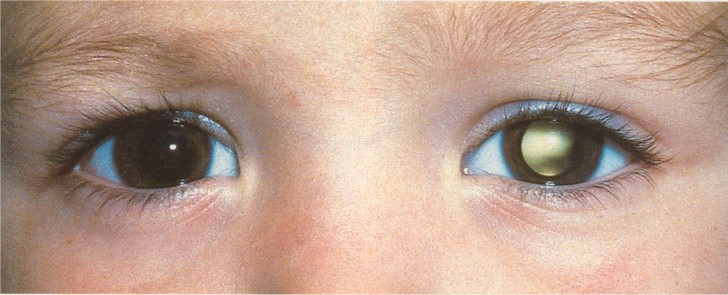10. Se guardando una foto vi accorgete che uno dei due occhi del soggetto ha questo riflesso, quasi certamente la persona avrà un retinoblastoma.