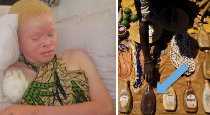 Risultati immagini per albini in tanzania