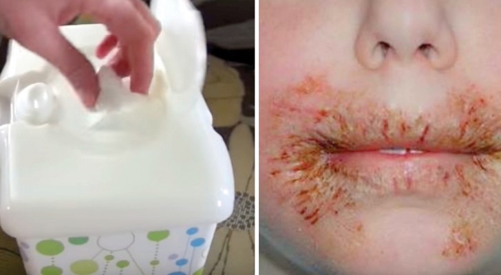 I dermatologi sconsigliano l'uso di salviette umide di bassa qualità: possono creare gravi allergie ai bambini