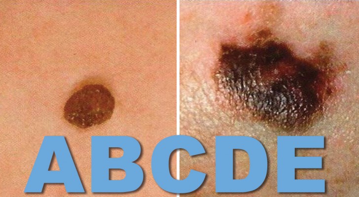 De ABCDE regel helpt je een goedaardige moedervlek van een melanoom onderscheiden. Iedereen zou dit ezelsbruggetje moeten kennen