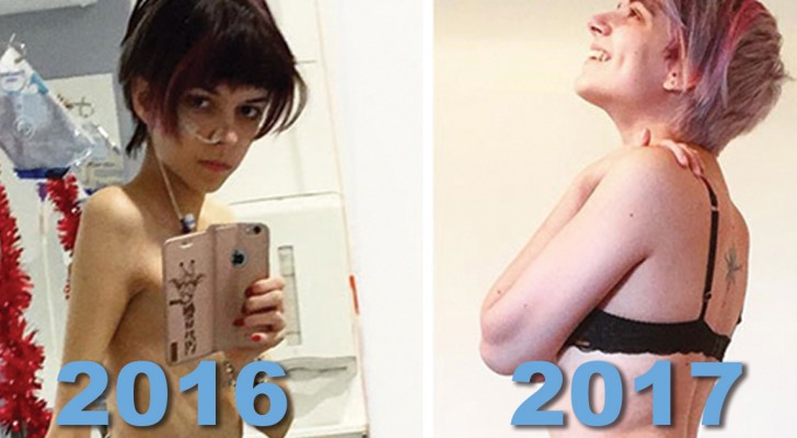 Die Magersucht besiegen: Diese Fotos von Leuten die es geschafft haben, brauchen keine Worte
