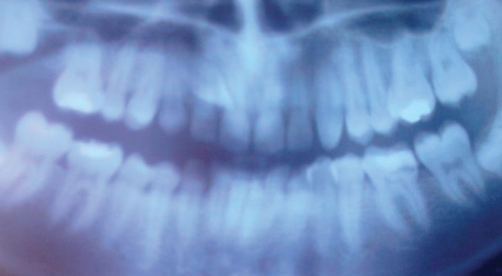 Vertigini, mal di schiena e problemi di postura: E se fosse colpa dei denti storti?