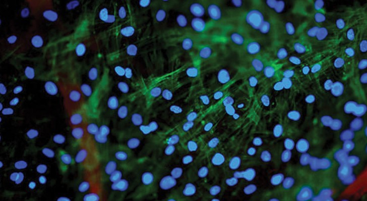 Effettuata a Milano la prima iniezione di cellule staminali nervose per curare la sclerosi multipla