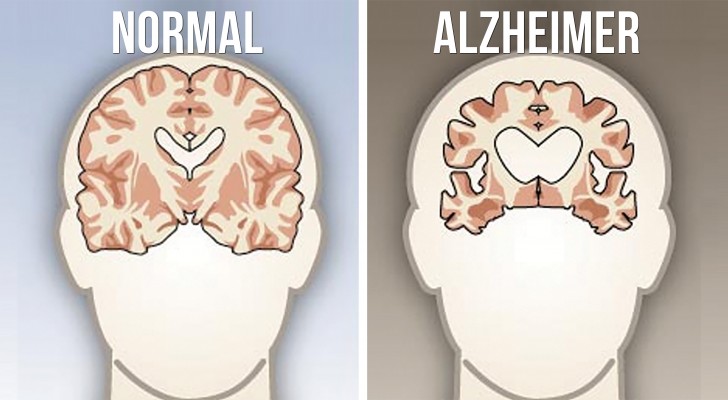 9 abitudini che devi attuare per evitare il morbo di Alzheimer e le altre malattie da demenza