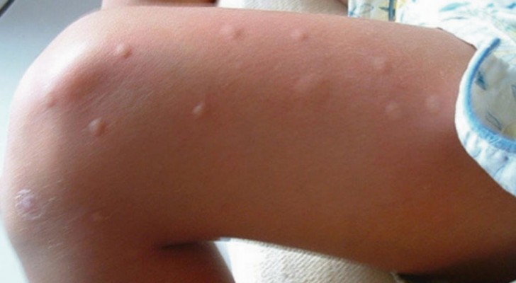 7 mögliche Gründe, warum die Mücken einige Menschen gegenüber anderen bevorzugen