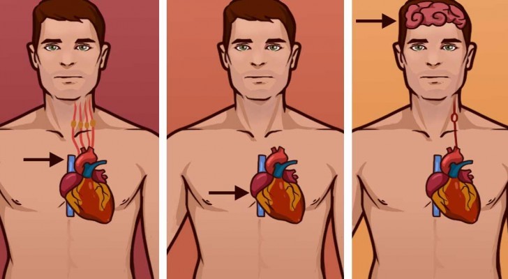 Erkenne den Unterschied zwischen einem Infarkt, einem Herzstillstand und einem Schlaganfall