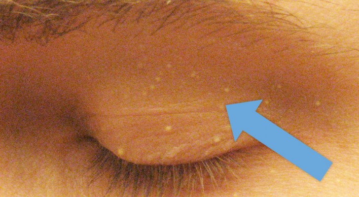 6 consigli per eliminare quei punti bianchi sugli occhi e vicino al naso