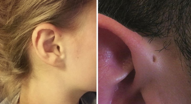 Some people have a tiny hole at the top of their outer ear and its origin is explained here 