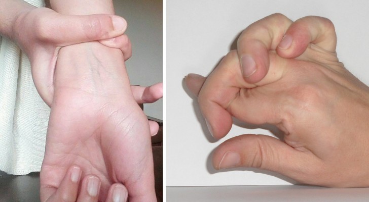 Sai compiere facilmente questi movimenti con le mani? Potresti essere affetto dalla Sindrome di Marfan