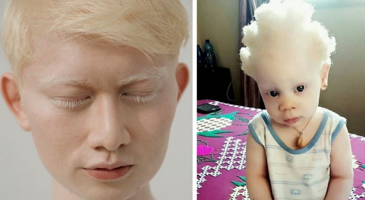 Voici comment sont les albinos du monde entier !