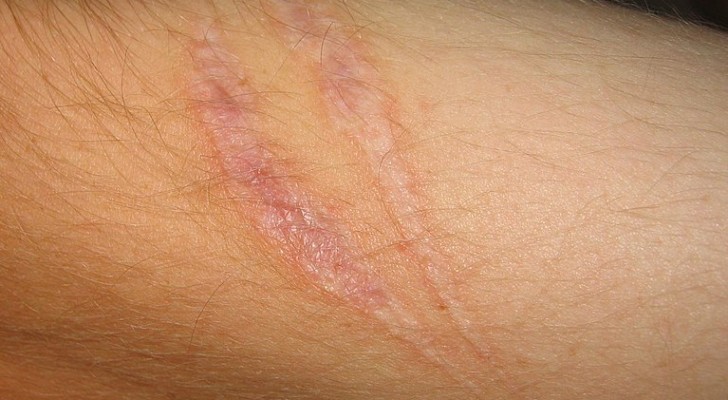 Gli scienziati di Harvard creano un cerotto che permette alle ferite di guarire senza lasciare cicatrici