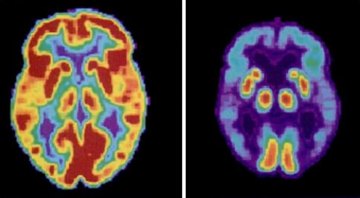 Una sola notte in bianco aumenta la produzione di tossine collegate alla comparsa dell'Alzheimer