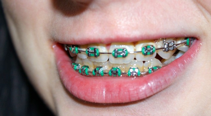 I dentisti avvertono che l'apparecchio ai denti potrebbe essere del tutto inutile: ecco cosa hanno scoperto