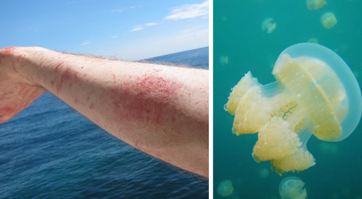 Cosa fare se vieni punto da una medusa questa estate